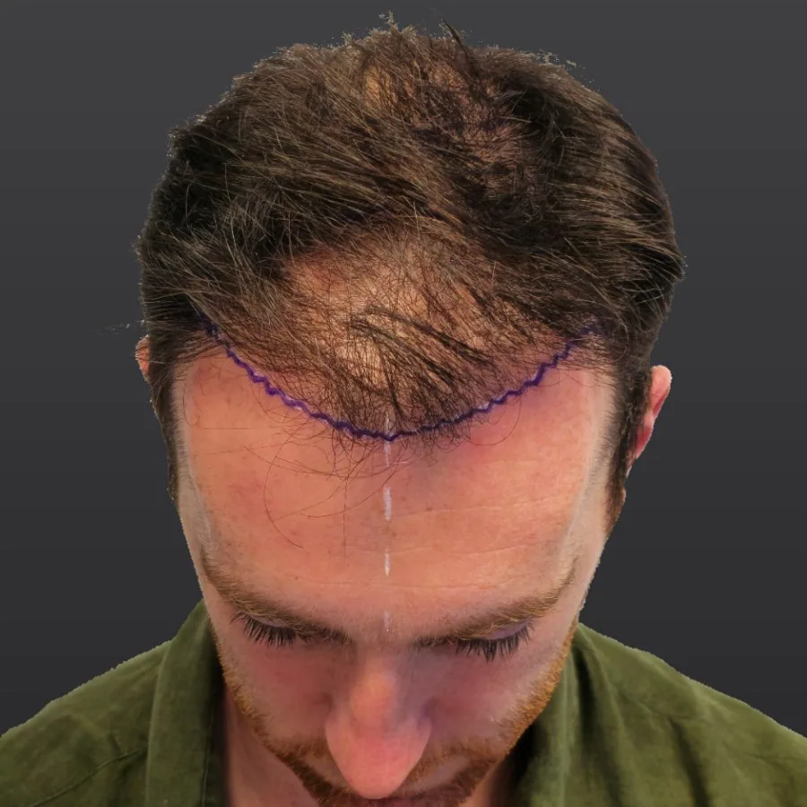 Dr Prosser on the day of his own hair transplant